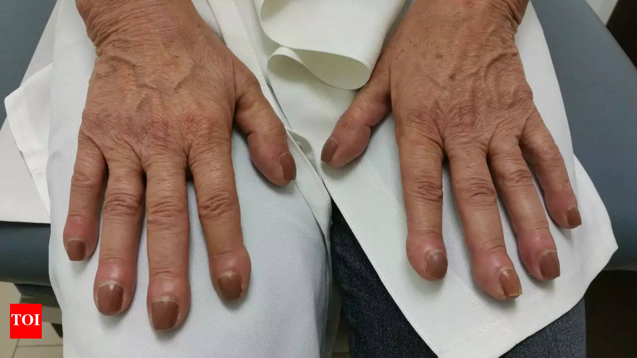 Clubbed Fingers Pictures