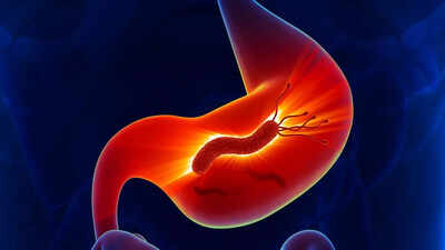 Millions of stomach cancer cases tied to a common bacteria: Who is at risk, early detection, and ways to prevent it