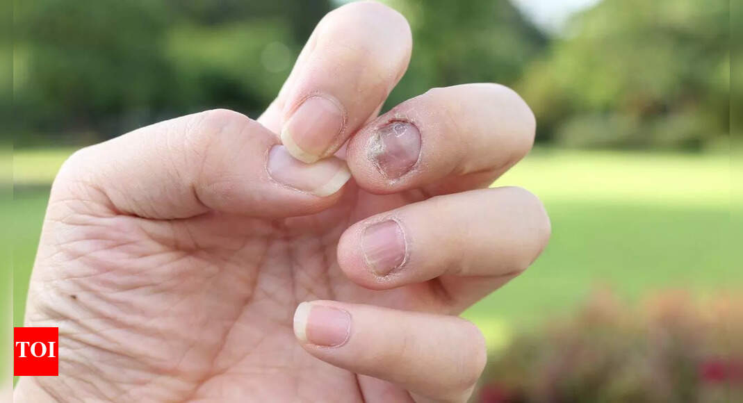 6 warning signs in the nails one should not ignore: They could be indicating serious health issues | – The Times of India