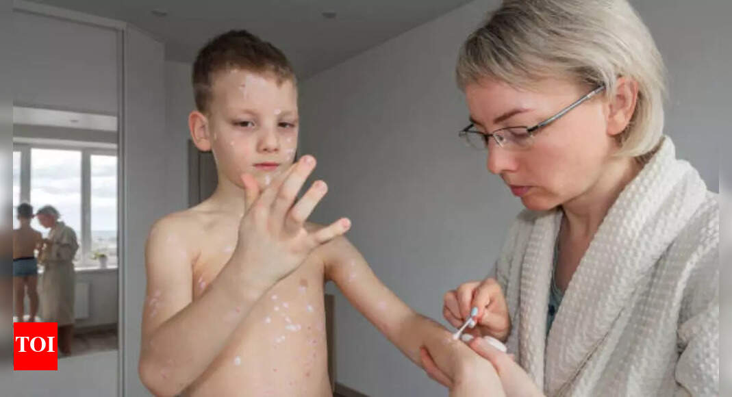 Why measles is spreading in the US - and Utah-Arizona border is the new hotspot
