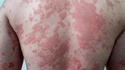 Obesity causes skin damage Obesity can damage your skin: Why dark patches, infections, and psoriasis are warning signs