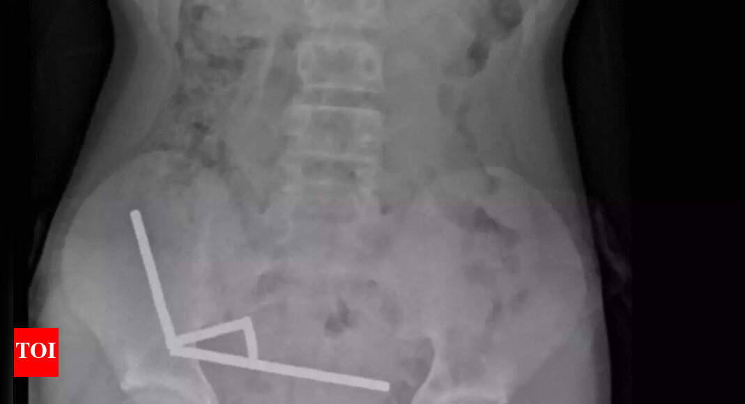 Teen’s 200-magnet ingestion leads to bowel surgery- the suprising reasons kids and teens swallow objects |