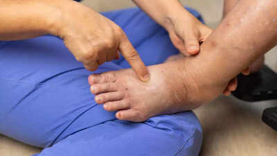 कैंसर के बाद लिम्फेडेमा के साथ रहना: सूजन और परेशानी को कम करने के कारणों, संकेतों और तरीकों को जानें