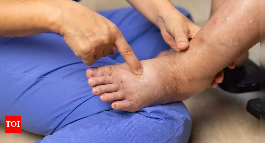Living with lymphedema after cancer: Know the causes, signs, and ways to reduce swelling and discomfort