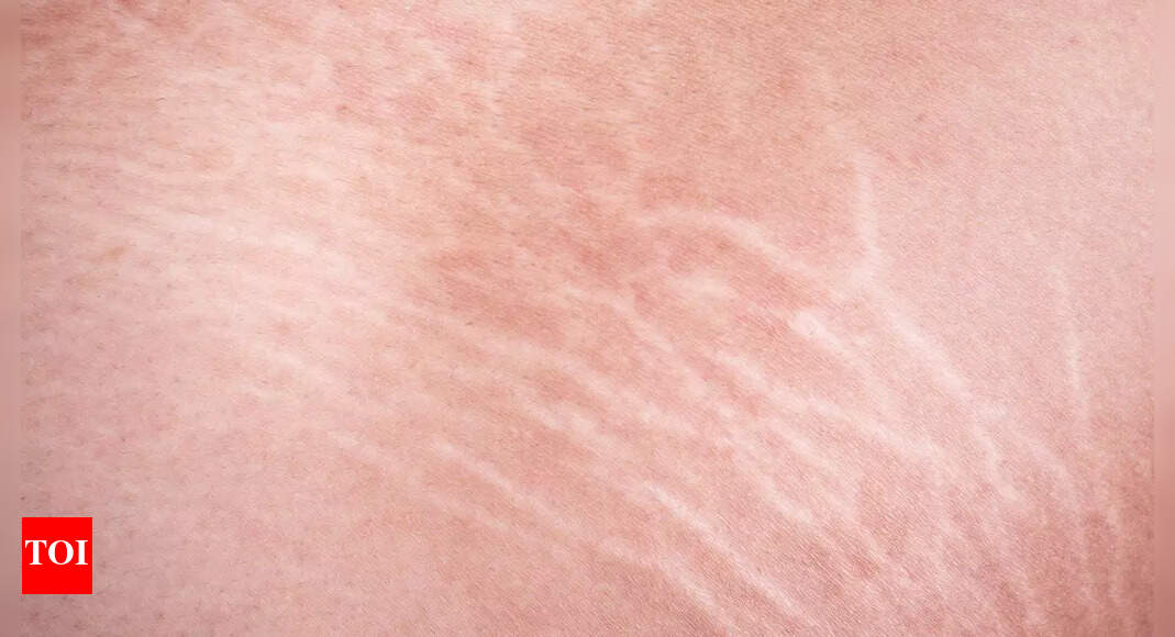 6 Effective tips to prevent stretch marks and improve skin elasticity |