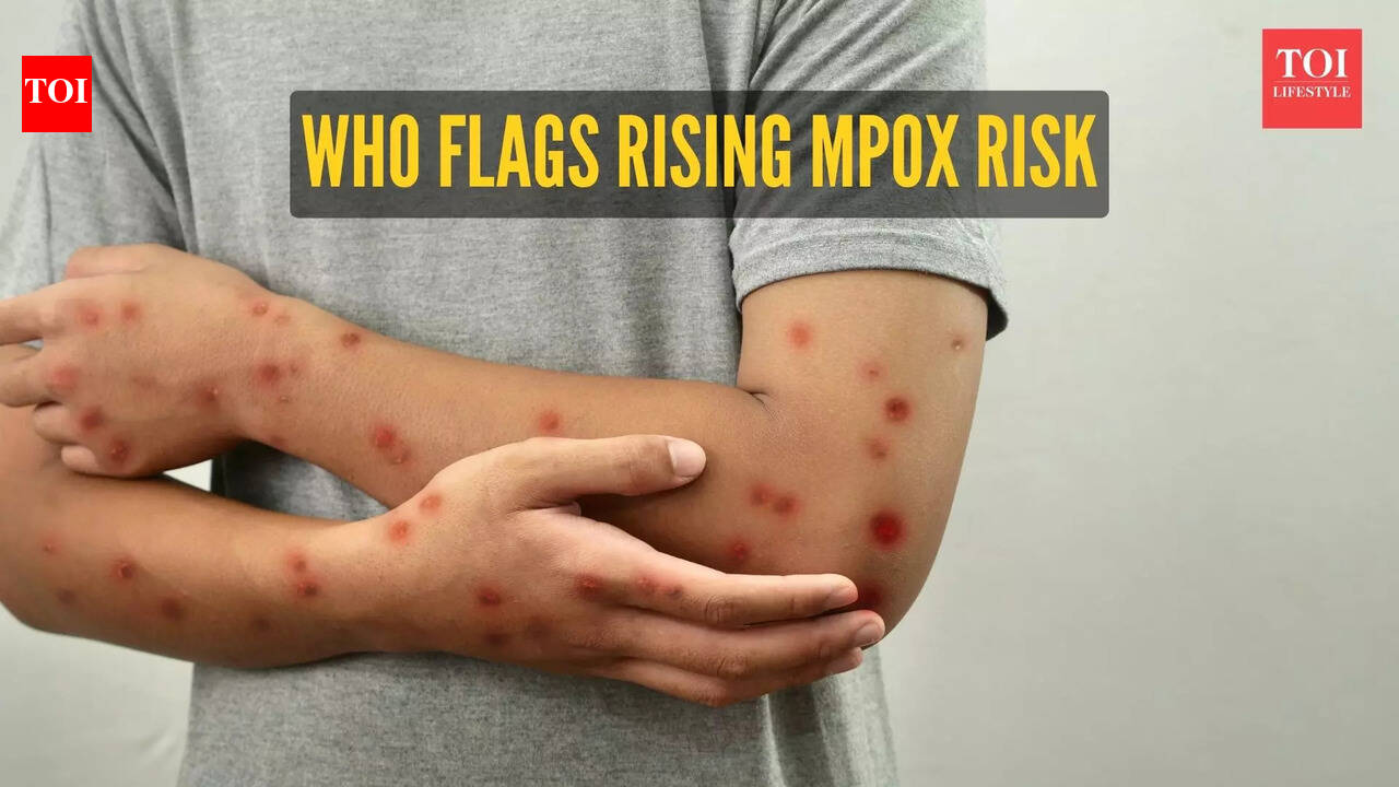 Clade Ib Mpox Symptoms: WHO warns of rising 'clade Ib' Mpox cases ...