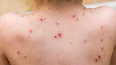 Foods to avoid when you have chickenpox: What to skip and what to eat for faster healing