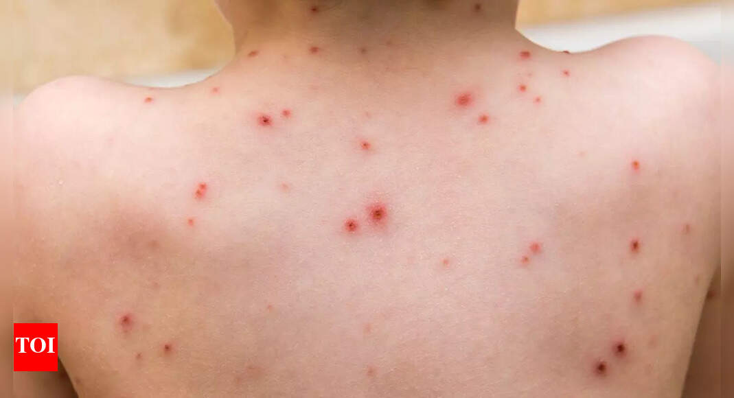 Foods to avoid when you have chickenpox: What to skip and what to eat for faster healing