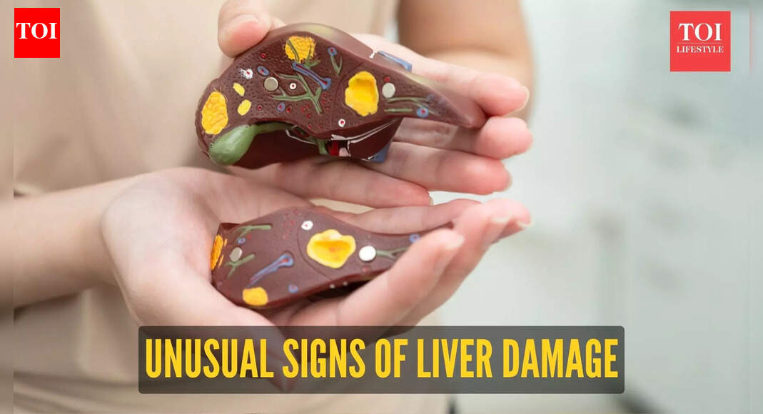 Liver Damage Symptoms: Liver damage shows up in the urine first: Spot ...