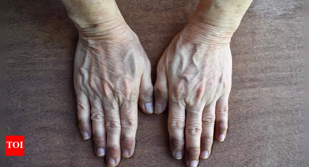 Why your hands or fingers turn blue: Understanding peripheral cyanosis, causes, and what it says about blood flow