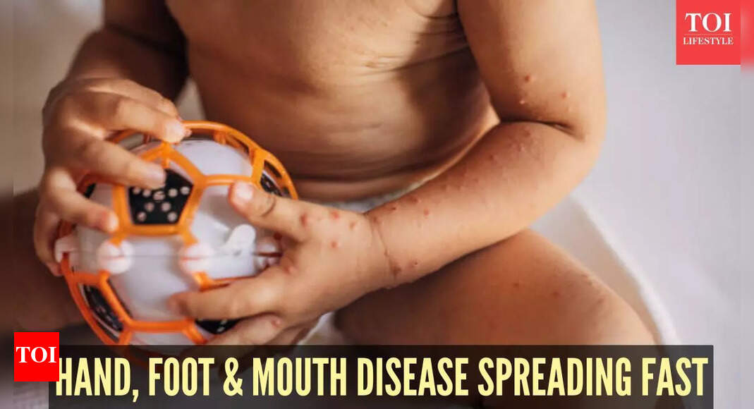 Hand, foot and mouth disease rise in the US: Doctors warn about symptoms, share prevention tips