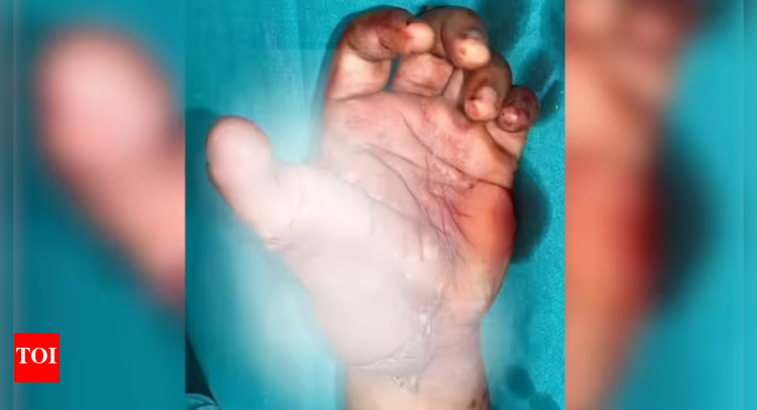 Remarkable surgery: Delhi surgeons use amputated toe to give Rewari youth new thumb
