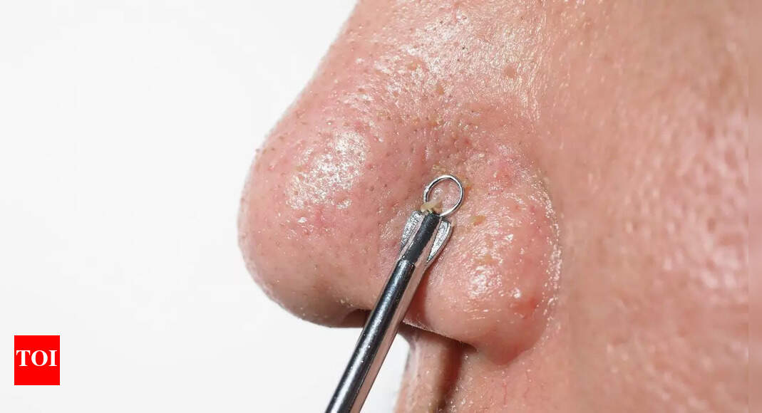 Remove blackheads naturally: 5 simple face masks you can make using kitchen ingredients