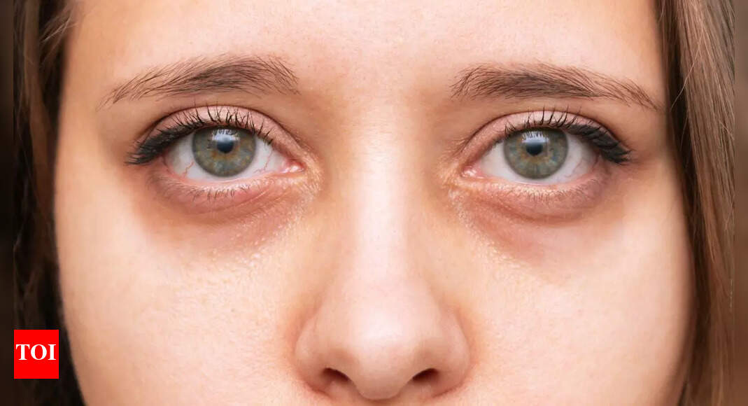 9 Foods that help reduce dark circles and brighten under-eye skin
