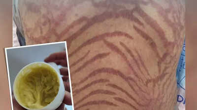 Chinese woman develops snake skin! Decade-long use of ‘pure’ TCM cream exposes shocking side effects
