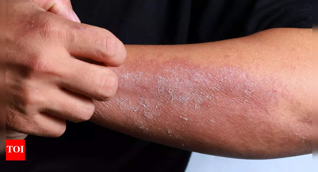 Itchy, dry skin on your hands, face, or knees? It could be eczema; know its causes, types, and symptoms