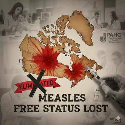 Canadá ya no está libre del sarampión mientras los brotes se propagan