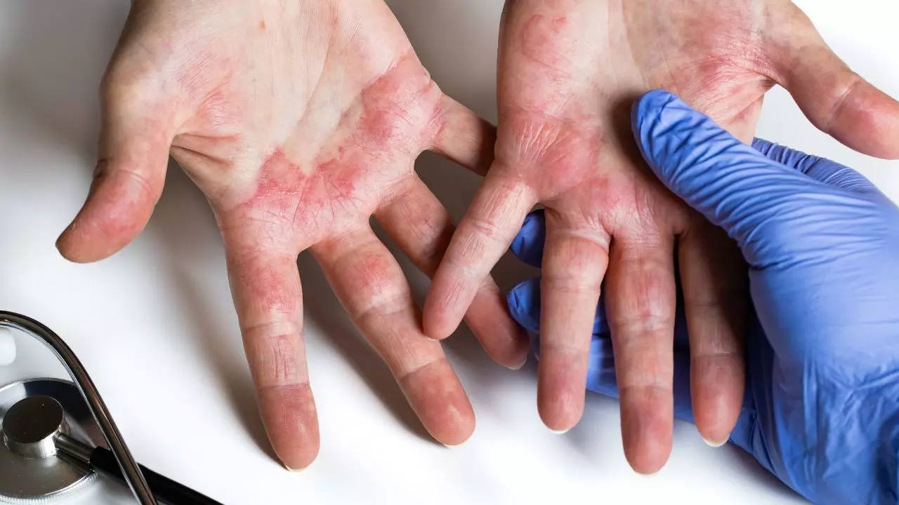 Allergic vs. Irritant Contact Dermatitis: Spot the difference between the two most common skin reactions