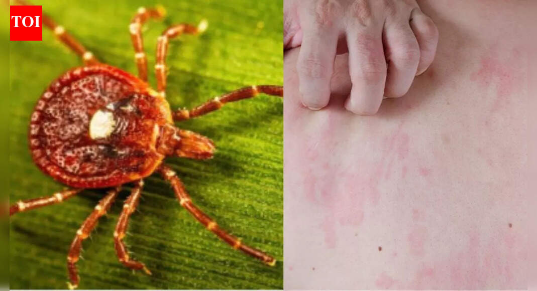 What is alpha-gal syndrome: Understanding how tick bites can turn red meat into a life-threatening allergy; symptoms and causes explained