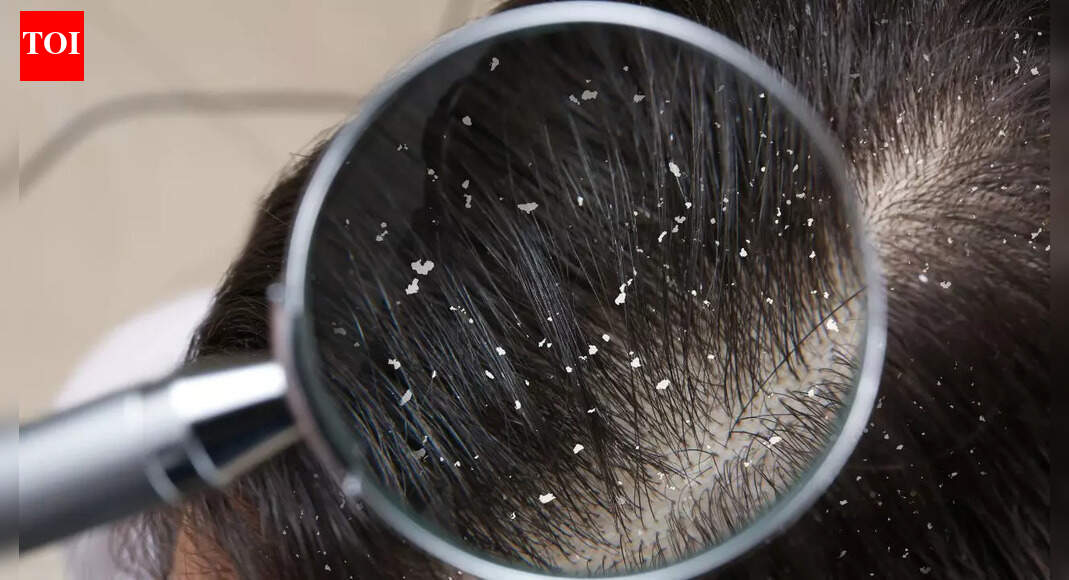 How zinc helps control dandruff and maintain a healthy, flake-free scalp