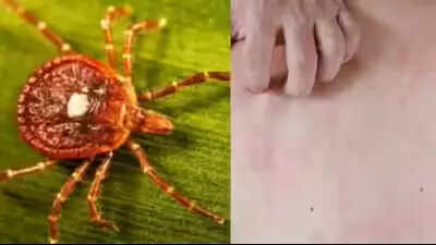 Qué es el síndrome alfa-gal: Comprender cómo las picaduras de garrapatas pueden convertir la carne roja en una alergia potencialmente mortal; síntomas y causas explicados