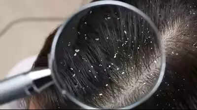 Cómo el zinc ayuda a controlar la caspa y a mantener un cuero cabelludo sano y sin escamas