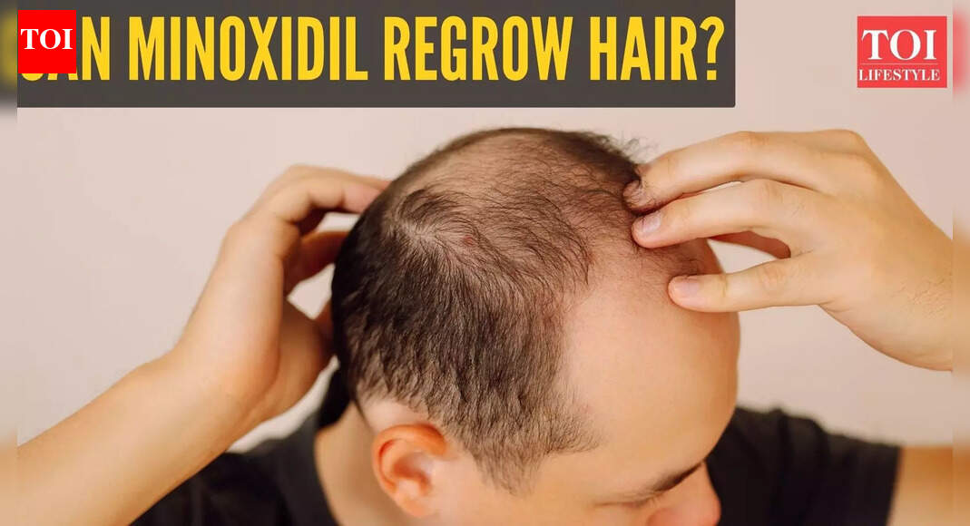 Can minoxidil help with hair growth? Online claims send the treatment trending
