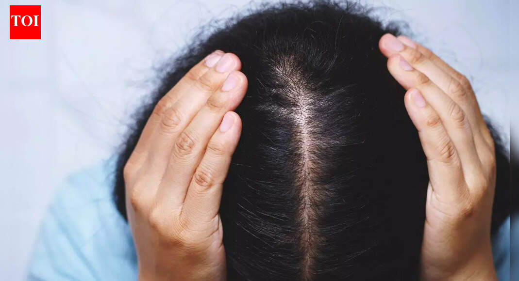 7 Home remedies for dry scalp in winter: Natural solutions to hydrate, soothe, and reduce flakes | – The Times of India