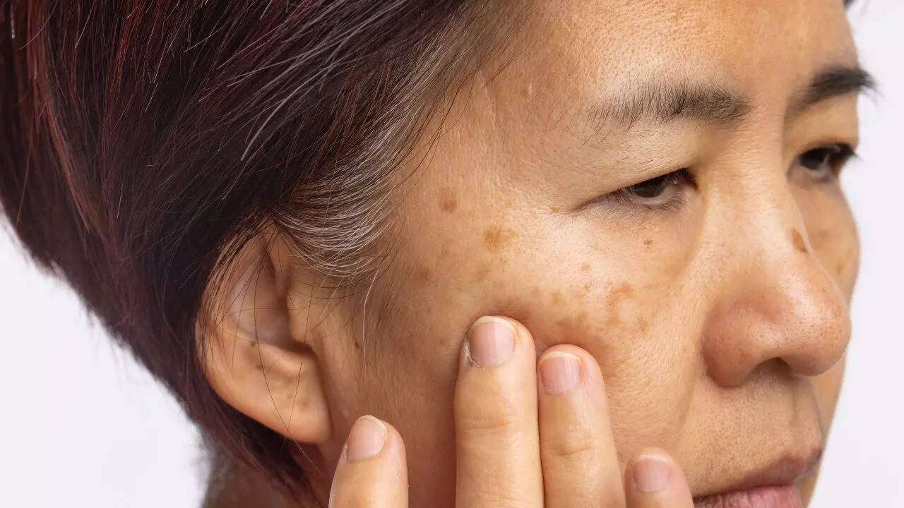 How Vitamin B12 deficiency shows up on your skin: Pigmentation, dryness,  inflammation, and other warning signs | - The Times of India