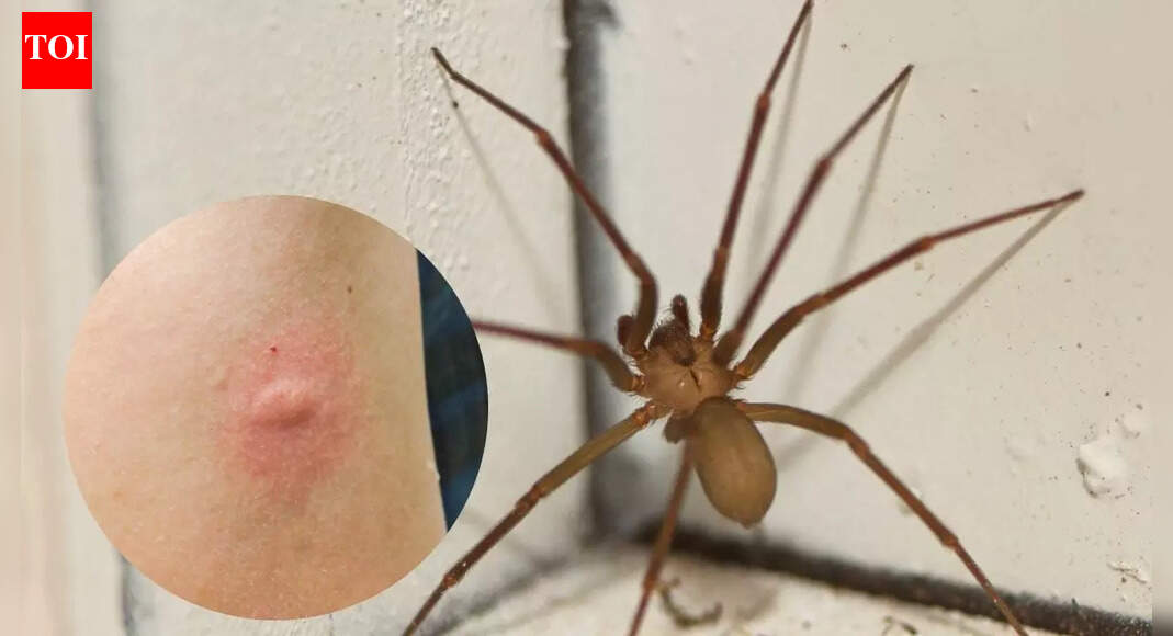 What to do if a spider bites you at home: Warning signs, symptoms, and when to seek help