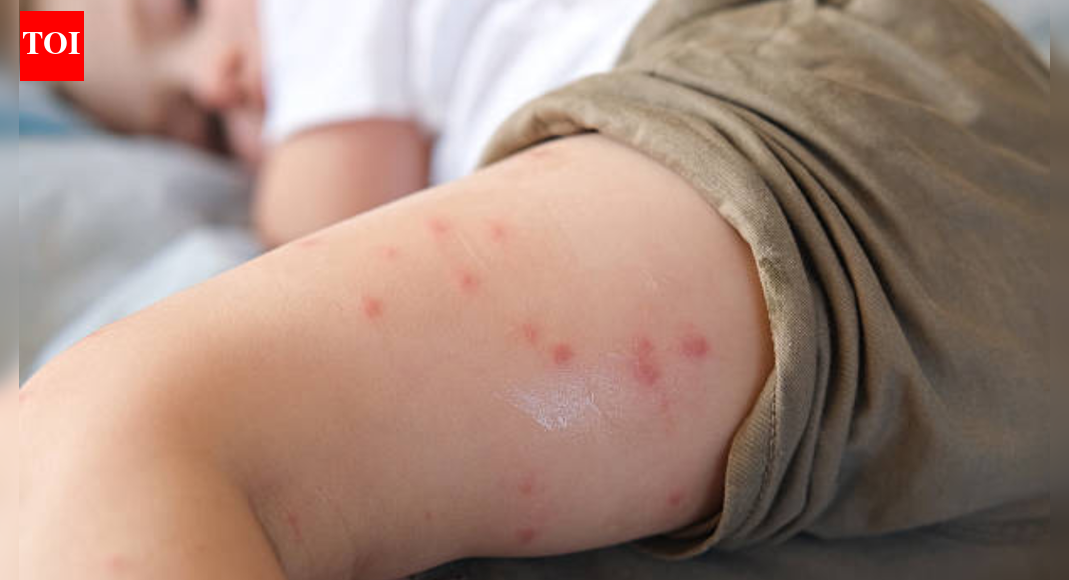 How to deal with mosquito bites for kids (and what to know about Skeeter Syndrome)