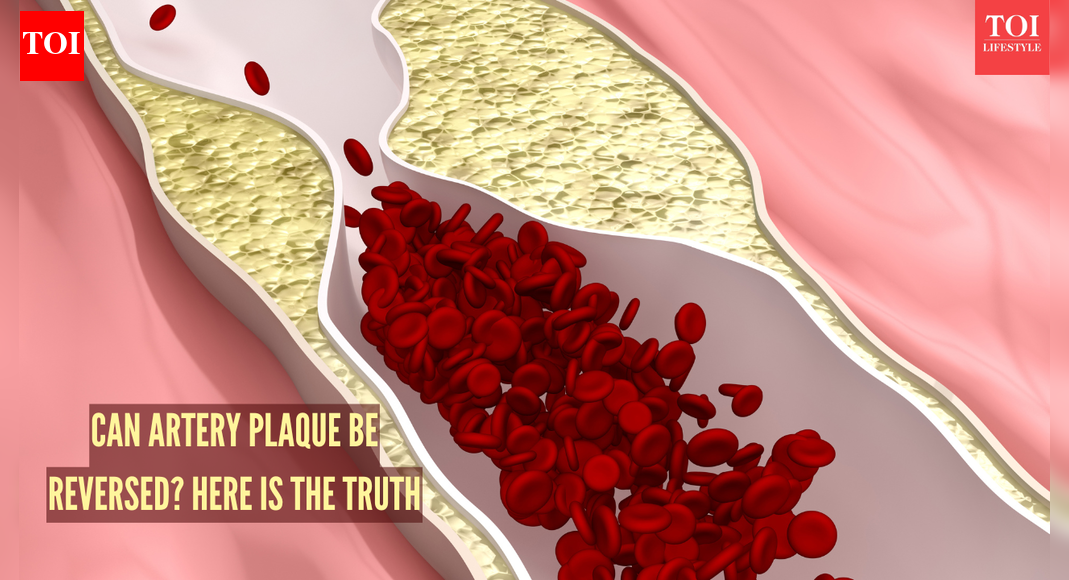 Can arterial plaque be reversed? Top U.S doc says...