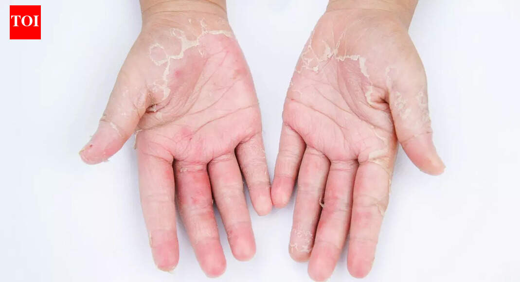 How to treat and prevent dry hands in winter