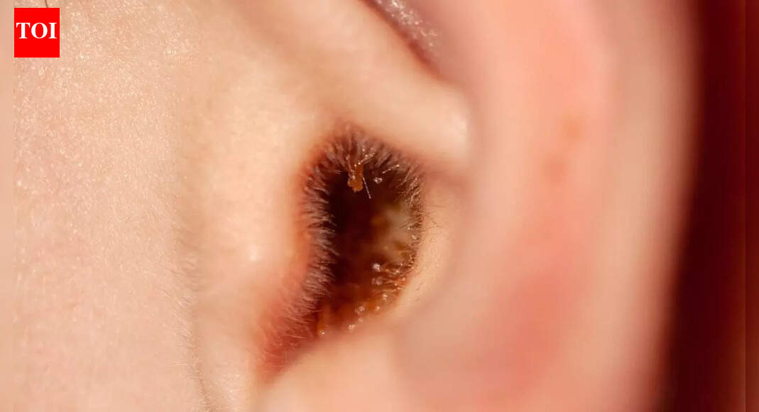 Why you should not use an earbud to clean earwax and what to do instead