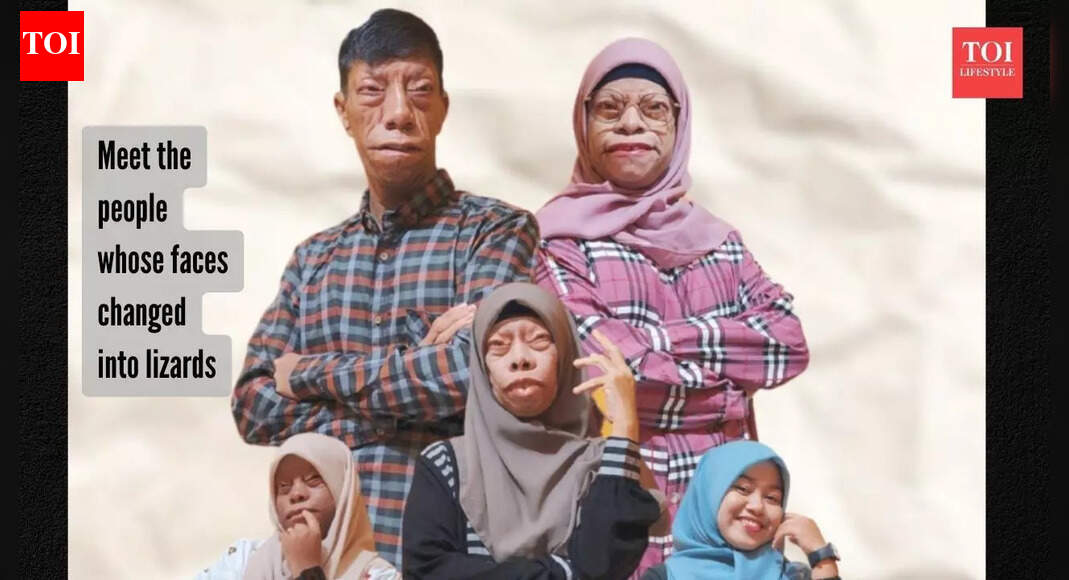 Lizard people: The people whose faces transformed over the years-- and how did this happen