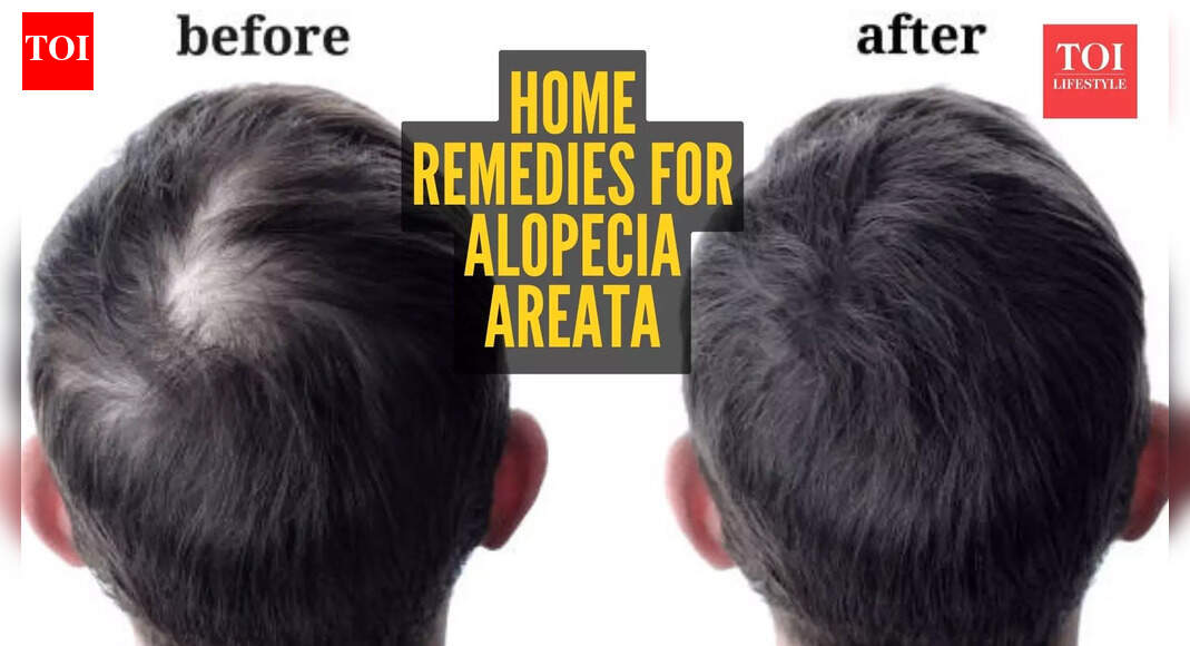 Alopecia Areata home remedies: 5 natural ways of reversing spot balding