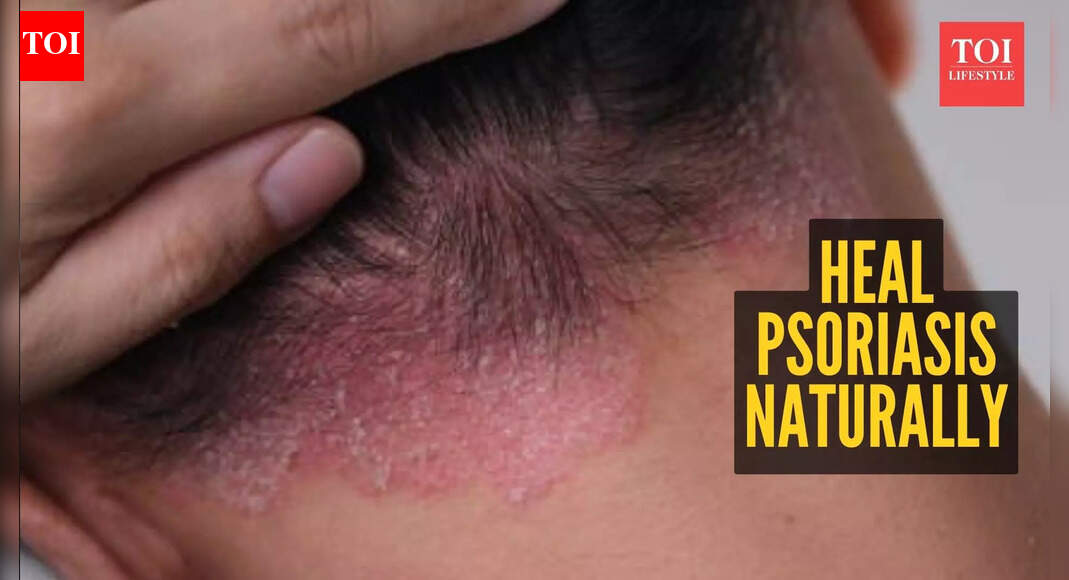 Home remedies that can help in reversing Psoriasis