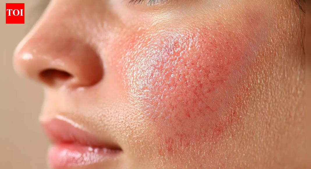 लीवर ख़राब होने के 5 त्वचा संबंधी लक्षण जिन्हें आपको नज़रअंदाज नहीं करना चाहिए |