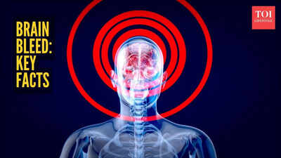 Swara Bhaskar’s father-in-law suffers brain haemorrhage: Understanding the medical condition and its symptoms