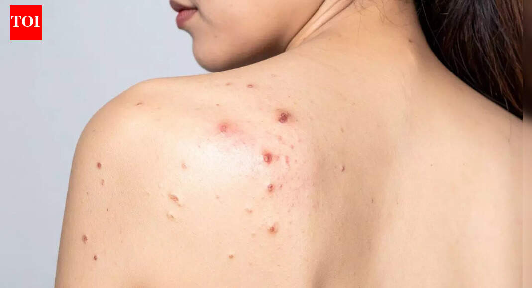 Do hot showers cause back acne: How heat, steam and sweat can worsen it