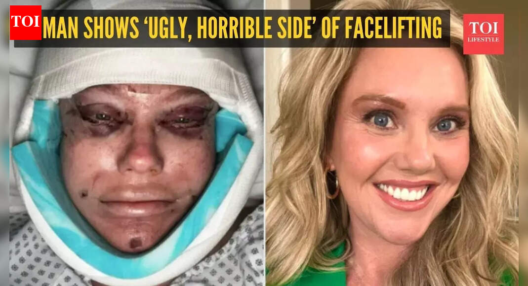 Woman on TikTok shows 'ugly, horrible side' of facelifting: 'What have I done?'