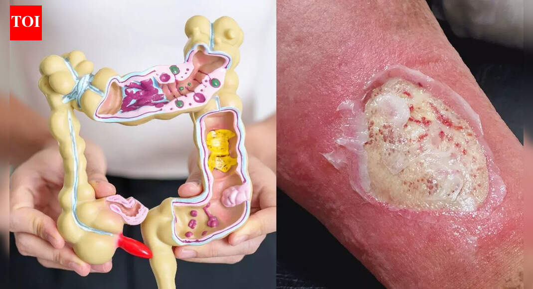 Colon cancer skin signs: 5 warning symptoms, prevention tips, and when to seek help