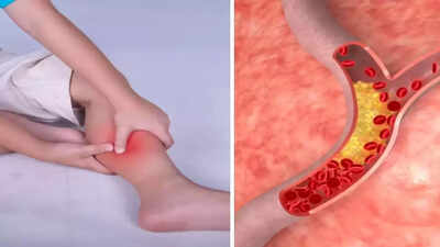 High cholesterol symptoms in legs at night: Pain, numbness, swelling, and other warning signs you should never ignore
