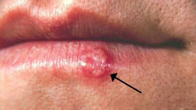 Herpes simplex virus: Understanding its symptoms, outbreak causes, how it spreads and tips for managing the infection