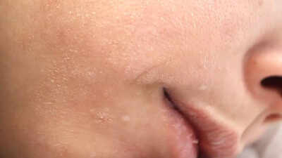 Understanding thyroid disorders: How hypothyroidism and hyperthyroidism impact skin, hair, and nail health