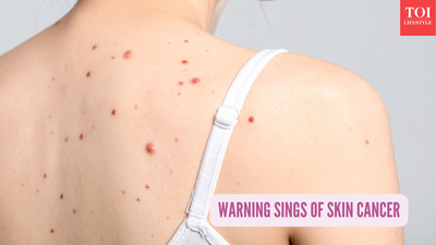 Board-certified cardiologist and dermat reveals 10 signs of skin cancer