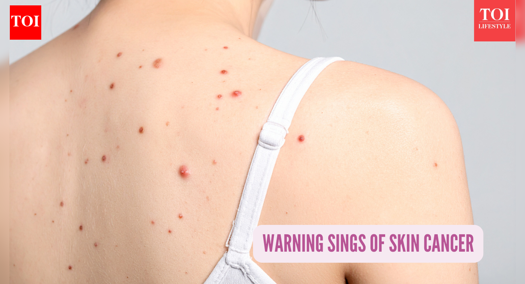 Board-certified cardiologist and dermat reveals 10 signs of skin cancer