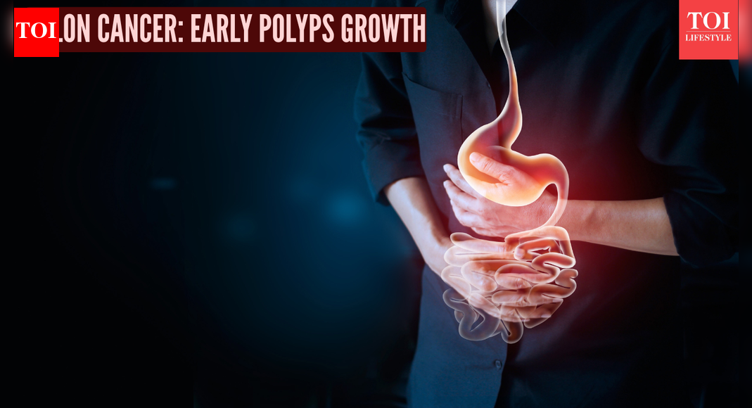 Colon Cancer: Doctor explains how silent polyps grow and why screening matters