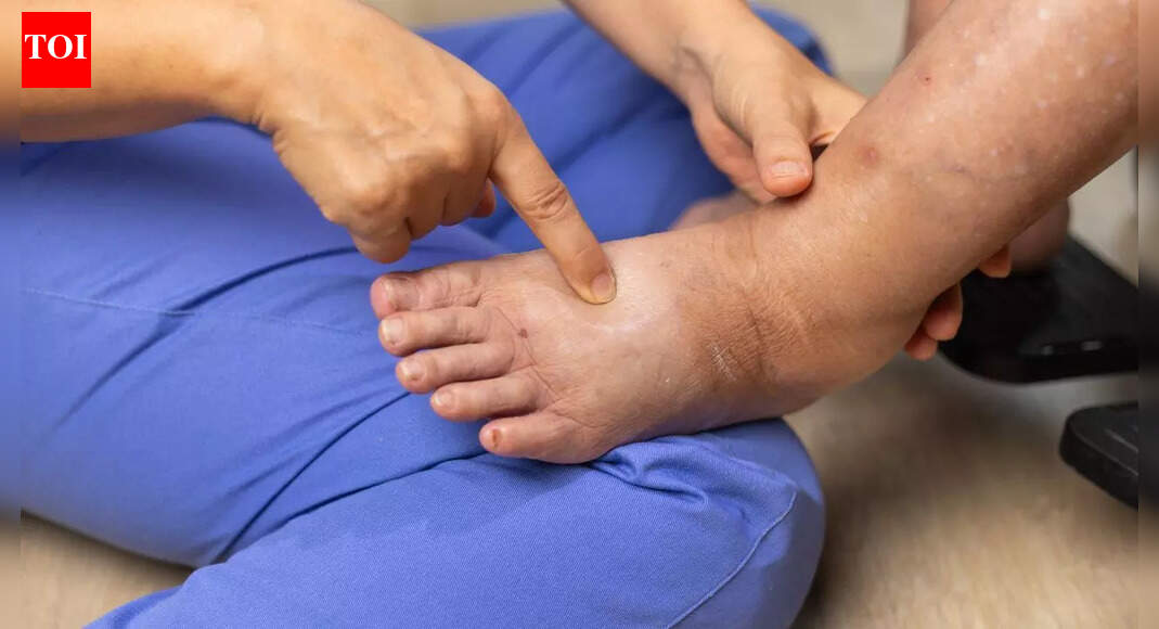 What causes swollen feet and ankles: The hidden reasons behind pedal oedema from heart, liver, kidney disease and DVT