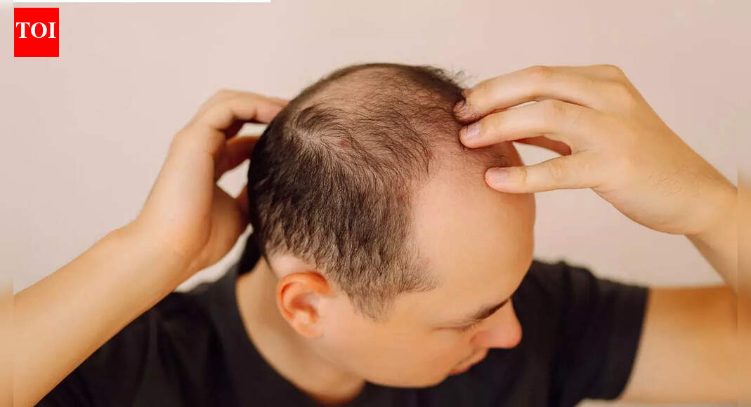 How an acne medicine may help reverse hair loss and baldness in males